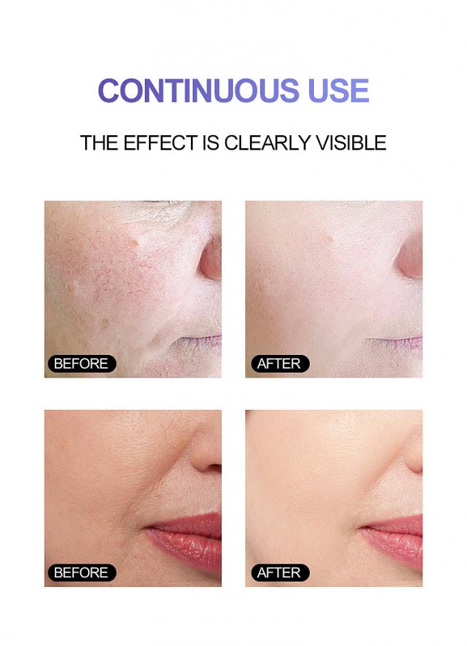 кожа предварительное Rosacea 1 чистой красноты сыворотки 100% стороны сути 30ml излучающая